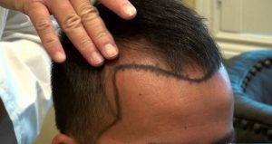 What are the profits of hair transplant surgeries