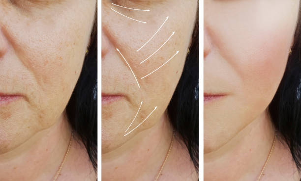 What Is Laser Skin Resurfacing And How Does It Work?