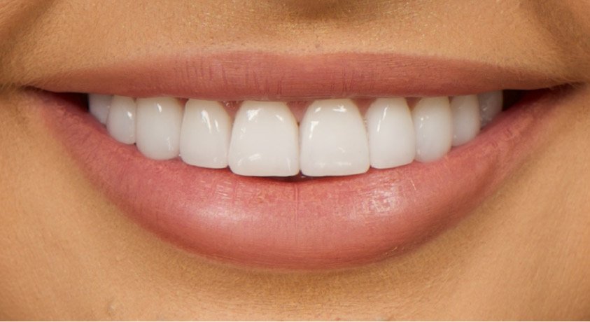 A Hollywood Smile: Achieving Perfection with Dental Veneers